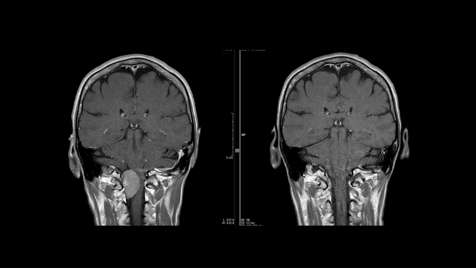 Meningioma del forame magno: confronto RM coronale, preoperatorio a sinistra e postoperatorio a destra.